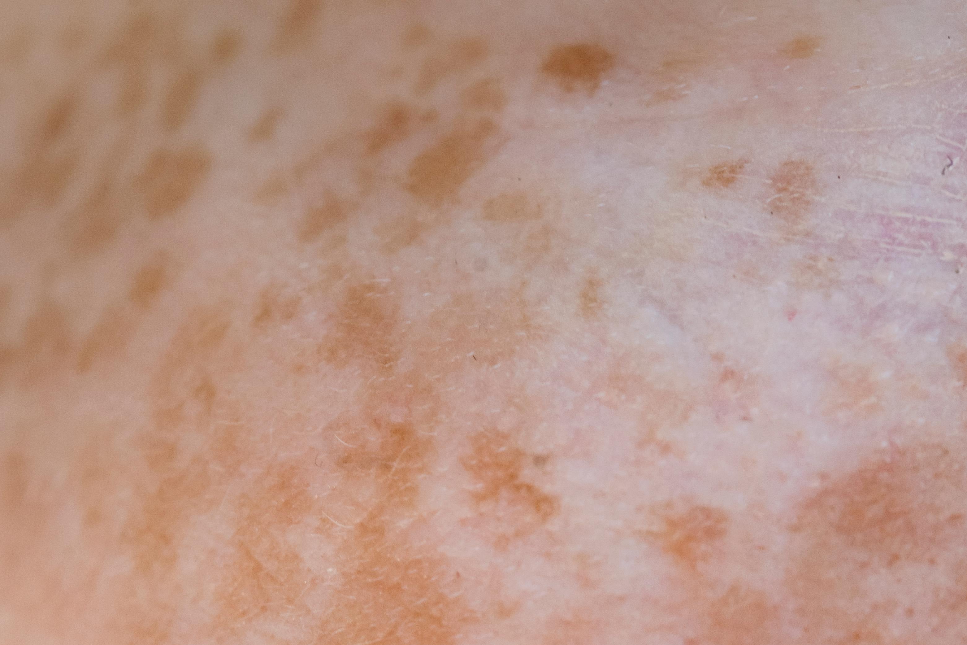 Why Pigmentation Keeps Coming Back (Even After Treatment)