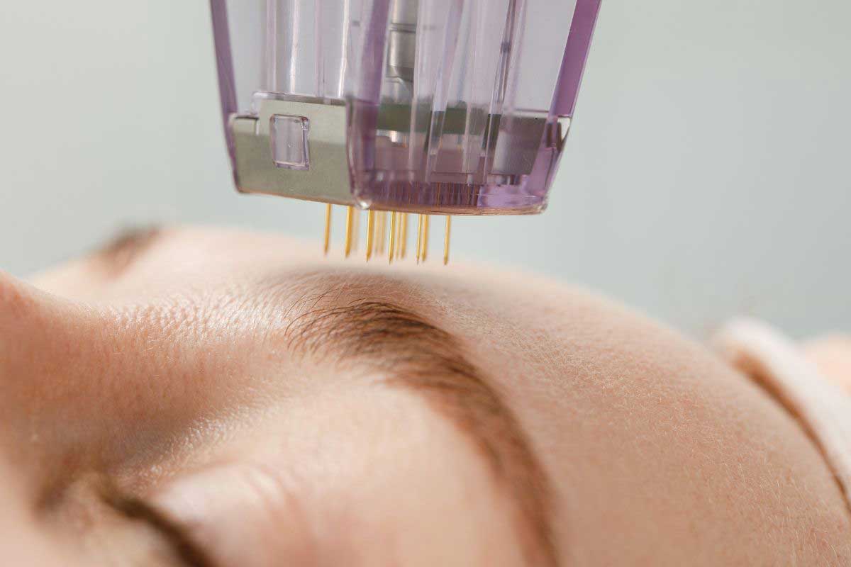 Microneedling in Oregon That Actually Works for Aging, Hormonal, or Sensitive Skin