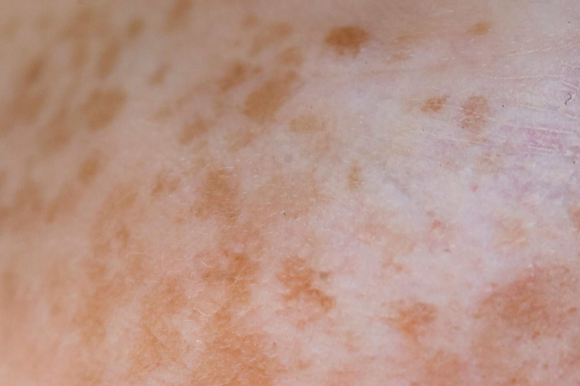 Why Pigmentation Keeps Coming Back (Even After Treatment)